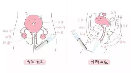 重庆五洲妇儿医院妇科专家 为什么用洗液 冲洗阴道 ,反而更痒了